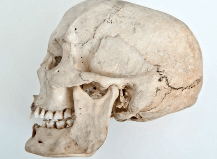 Cráneo de una persona con exostosis