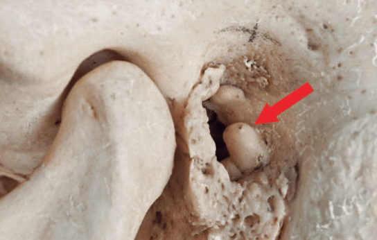 Detalle del cráneo con el hueso del oído crecido