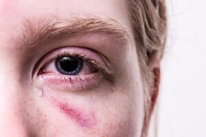 foto violencia agresión maltrato malos tratos física golpe morado ojo